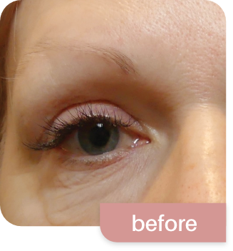 Morpheus8-before and after photos