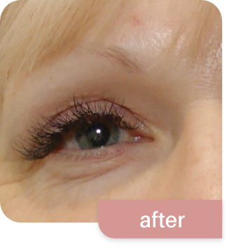 Morpheus8-before and after photos