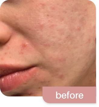 Morpheus8-before and after photos