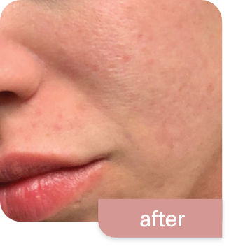 Morpheus8-before and after photos