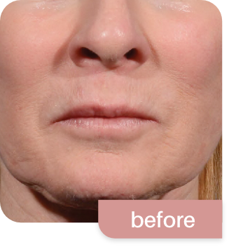 Morpheus8-before and after photos