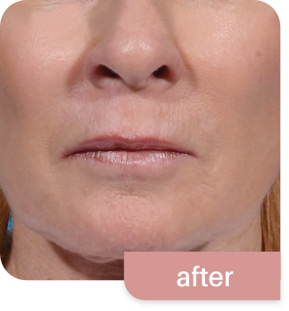 Morpheus8-before and after photos