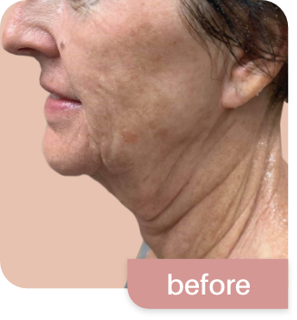 Morpheus8-before and after photos