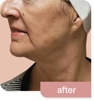 Morpheus8-before and after photos